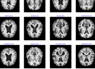 EARLY DETECTION OF ALZHEIMER DISEASE: AMULTIDISCPLINARY APPROACH ADVANTAGES IN EARLY DETECTION OF ALZEIMER’S DISEASE: A MULTIDISCPLINARY APPROACH
